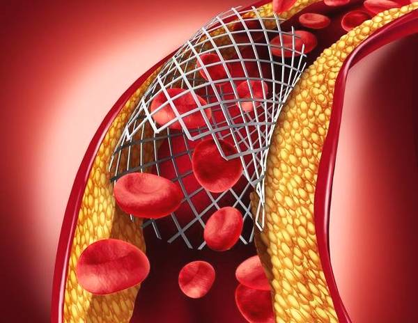 【力美新材料】生物可吸收支架獲批，近百萬冠心病患者或因此受益